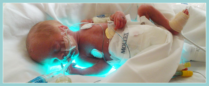 Photo of a preterm child in an incubator.