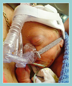 Photo of preterm child using Continuous Positive Airway Pressure (CPAP)