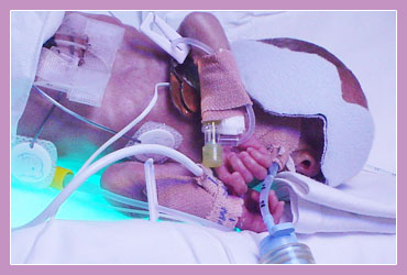 Photo of child experiencing Mechanical Ventilation