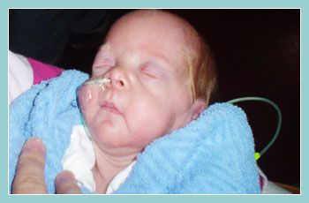 Photo of infant tube feeding.